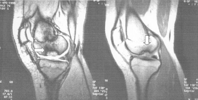 x-ray sa osteochondrosis dissecans sa tuhod joint