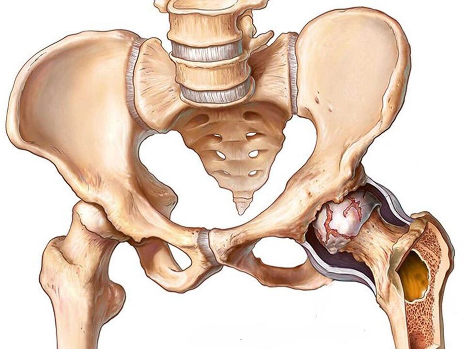 arthrosis sa hip joint