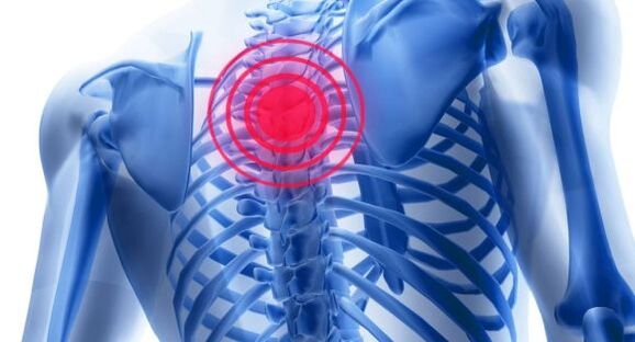 Pagtambal sa osteochondrosis sa thoracic spine