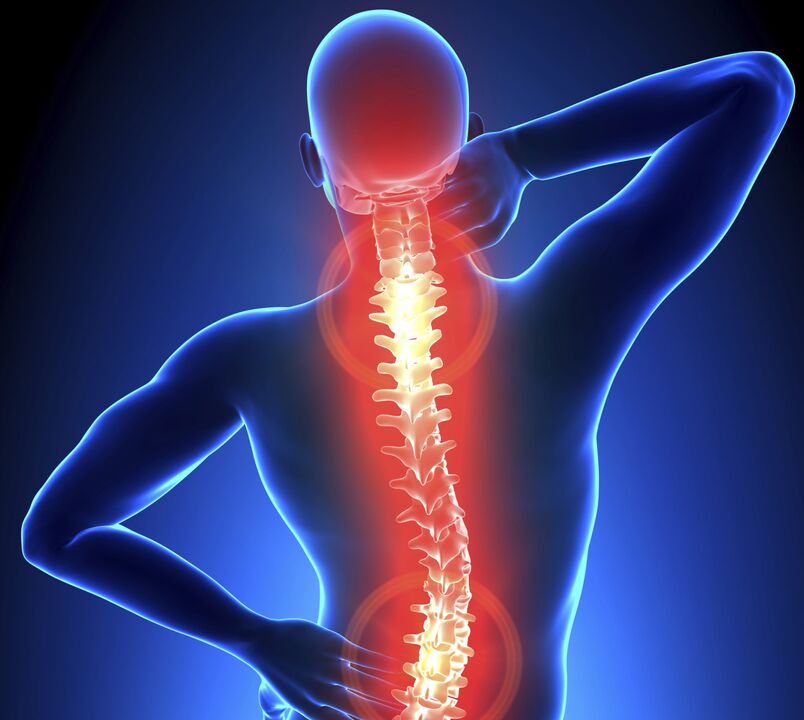 Osteochondrosis sa spine