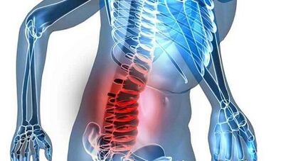 Mga timailhan ug mga Sintomas sa Lumbar Osteochondrosis