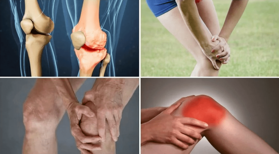 Mga Sintomas sa Arthrosis