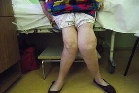 advanced arthrosis sa lutahan sa tuhod