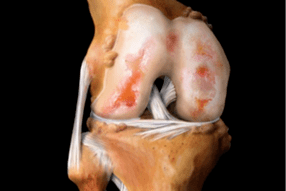 kadaot sa lutahan sa tuhod tungod sa arthrosis