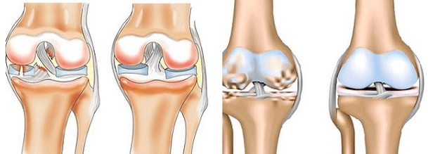 Arthritis ug Arthrosis