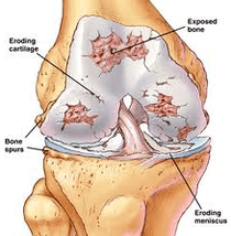 Ang mekanismo sa pag-uswag sa arthrosis